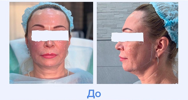 До процедуры 
