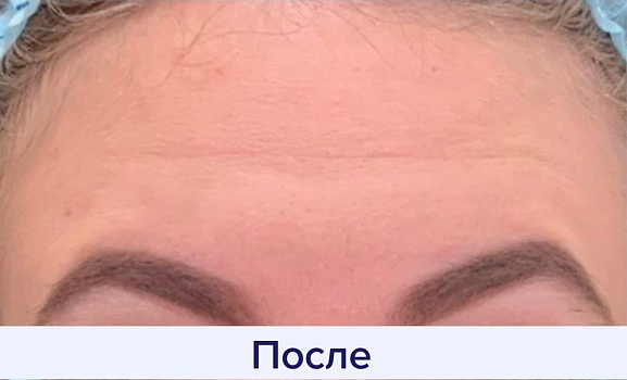 После процедуры 