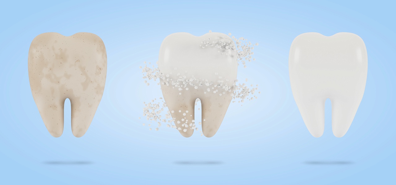 Зубной налёт и камень: причины образования и способы удаления