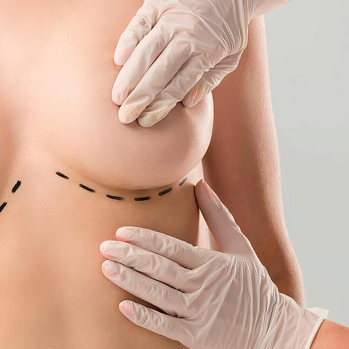 Уменьшение груди (редукционная маммопластика)