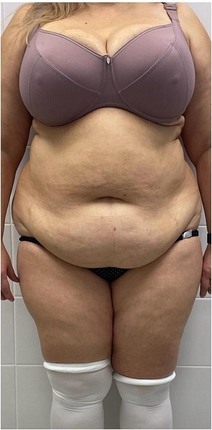 До операции 