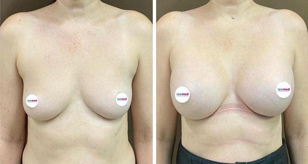 Увеличение груди круглыми имплантами