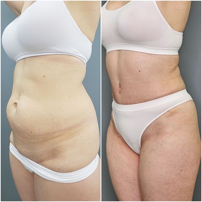 Пластика живота (абдоминопластика) Пластика живота (абдоминопластика)