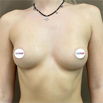 До операции 