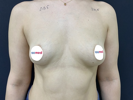 До операции 