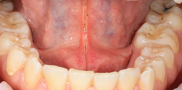 После лечения 