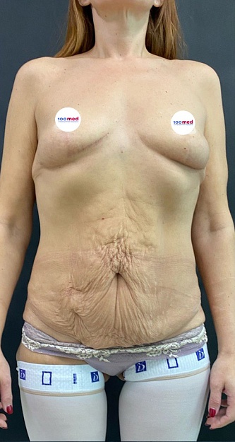 До операции 