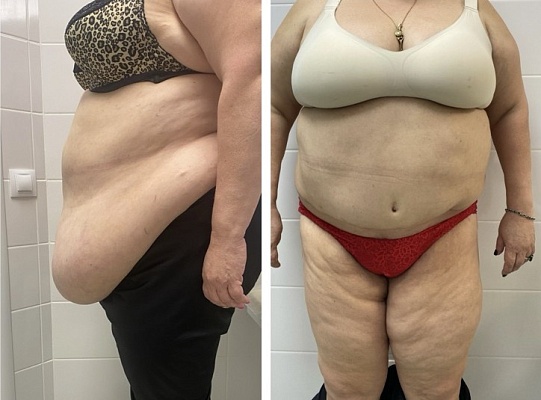 Абдоминопластика