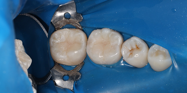 После лечения 