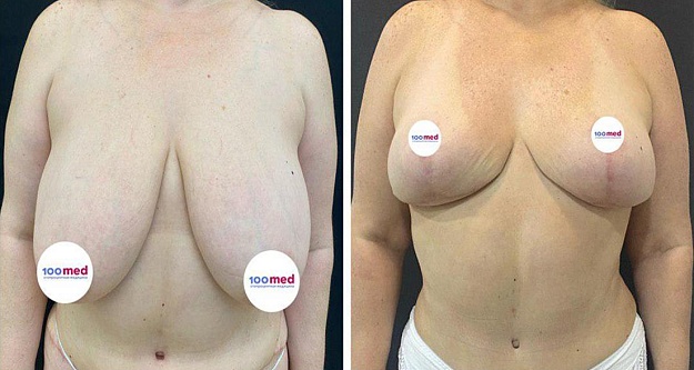 Редукционная маммопластика