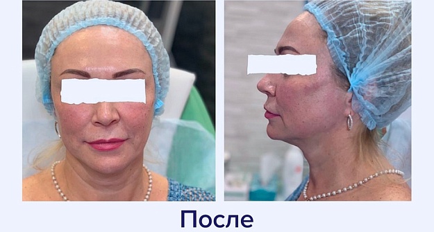 После процедуры 
