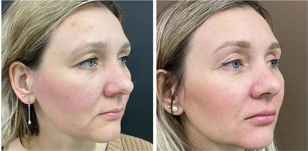 Эндоскопическая подтяжка лба, верхняя блефаропластика, SMAS-подтяжка лица