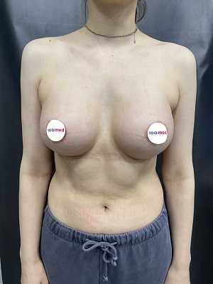 Эндопротезирование молочных желез имплантами mentor 375 ml. Централизация ареол.