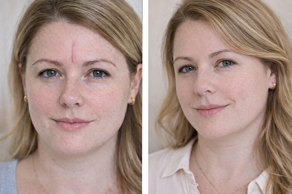 Удаление рубцов на аппарате DEKA SmartXide Punto.