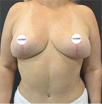 После операции 