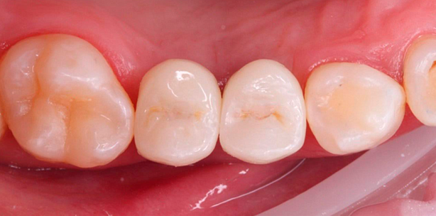 После лечения 