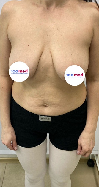 До операции 