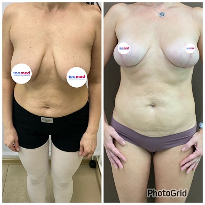 Подтяжка молочных желез