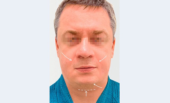 Эффект после процедуры 