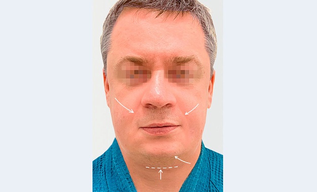 SMAS-лифтинг на Double HiFu