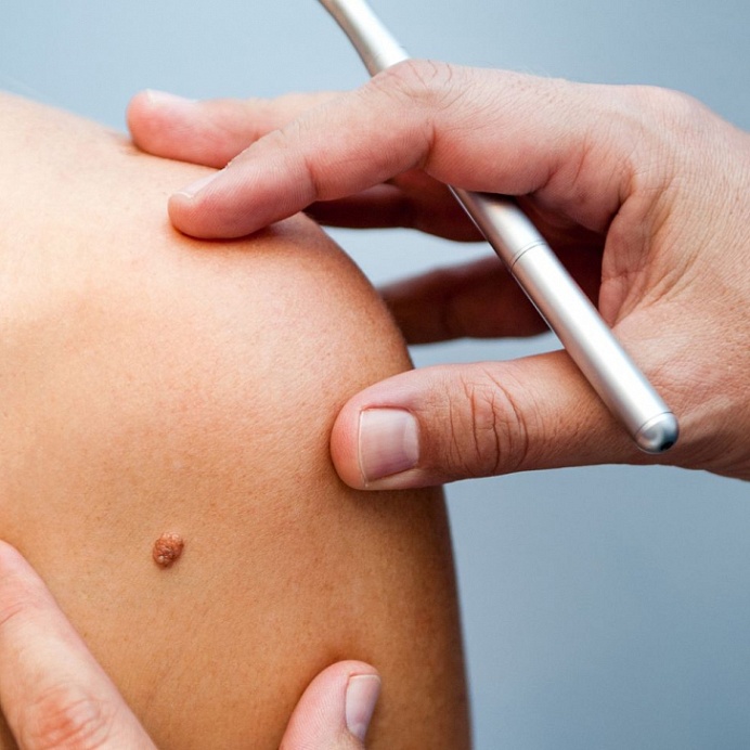 Удаление бородавок