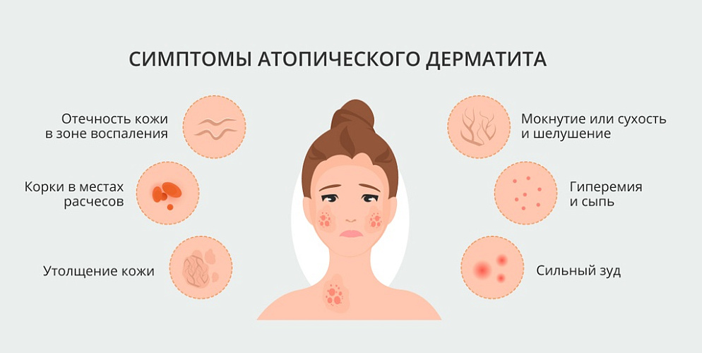 Симптомы