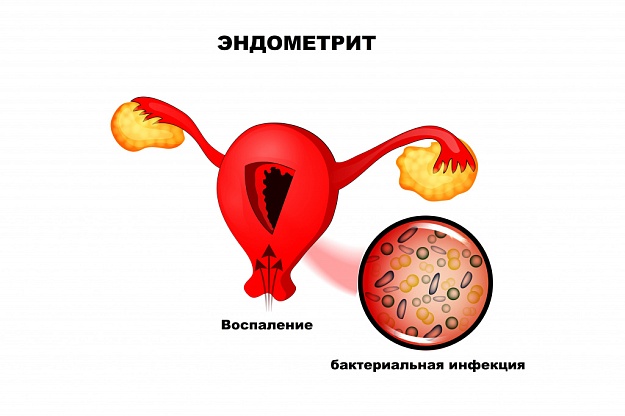 Классификация воспаления эндометрия