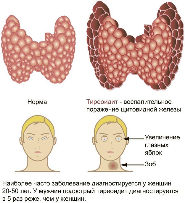 Симптомы