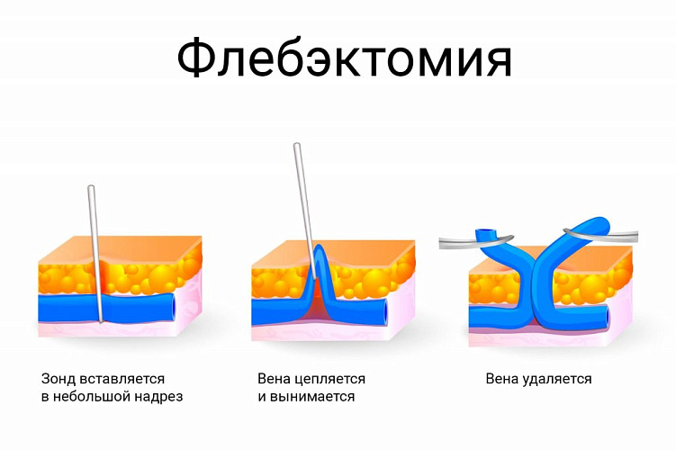 Подготовка и проведение минифлебэктомии в Москве и Люберцах