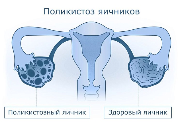 Что такое СПКЯ?
