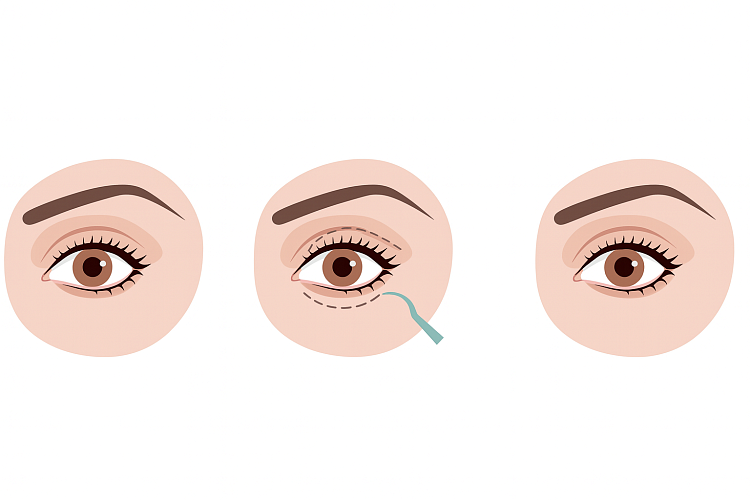 Как проводится верхняя блефаропластика