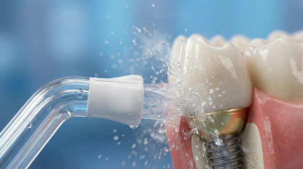 Имплант — на всю жизнь, если о нем заботиться