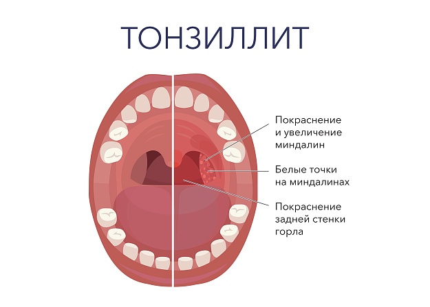 Симптомы тонзиллита