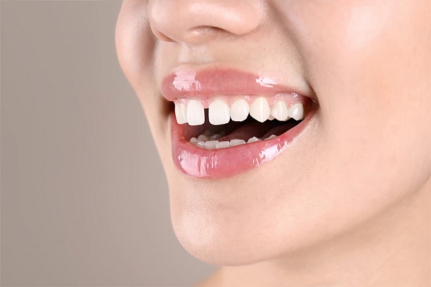 Идеальная улыбка без щелей — это реально