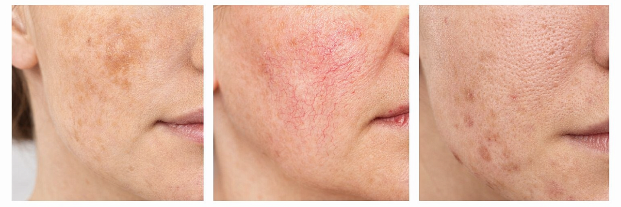 Какие проблемы решает лазерная косметология