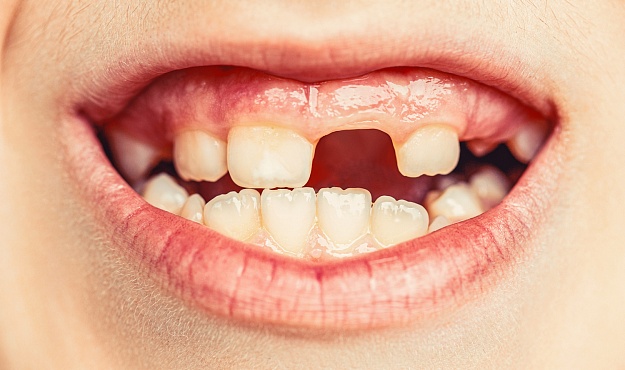 Как понять, что зуб скоро выпадет? Признаки