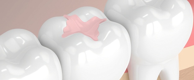 Вкладка: инвестиция в долговечность и здоровье зуба