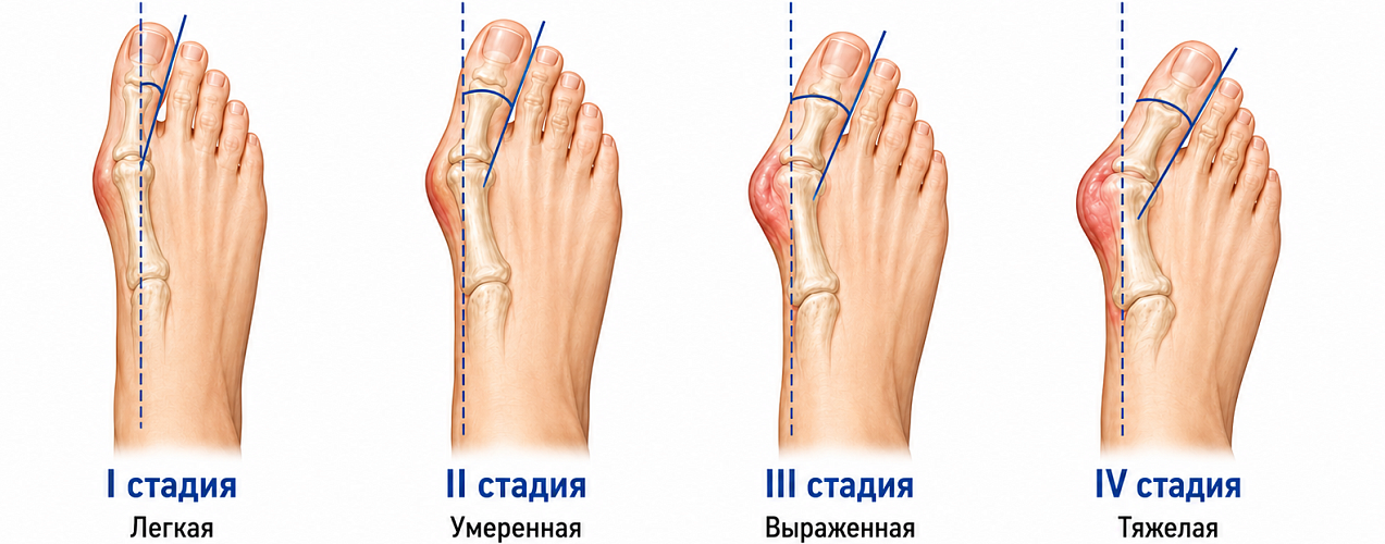 Что такое халюс вальгус