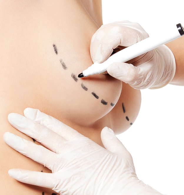 Этапы подготовки к мастопексии