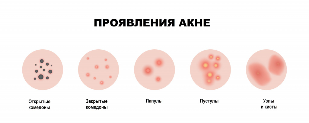 Симптомы